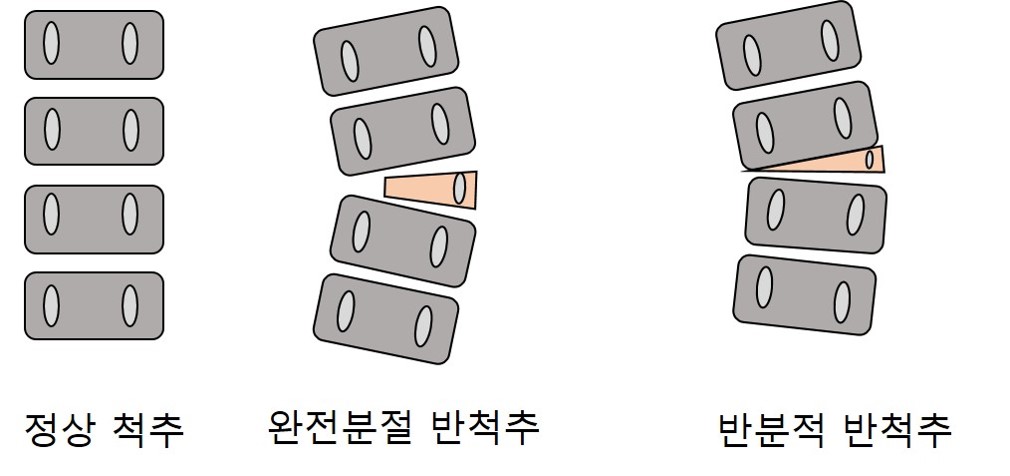 정상척추와 비교 그림
