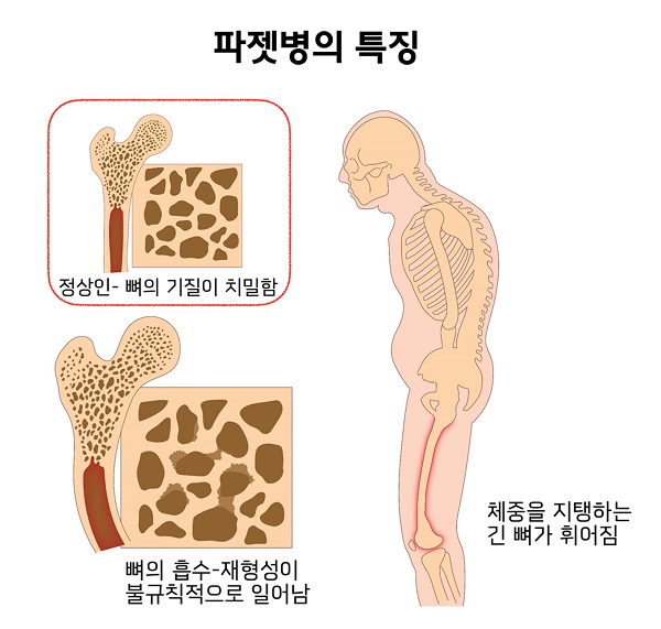 파젯병의 특징 그림: 정상인-뼈의 기질이 치밀함, 뼈의 흡수-재형성이 불규칙적으로 일어남, 체중을 지탱하는 긴 뼈가 휘어짐.