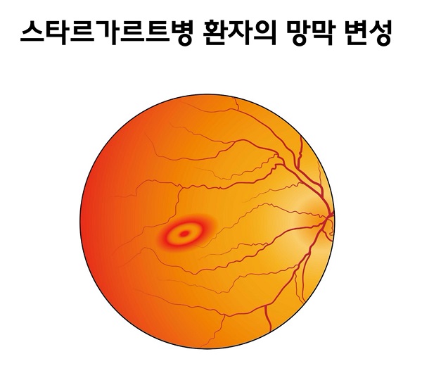 스타르가르트병 환자의 망막 변성 그림