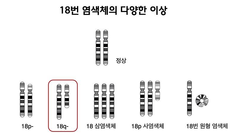 18번 염색체의 다양한 이상 그림