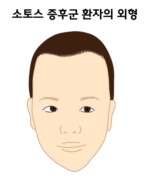 소토스 증후군 환자의 외형 그림
