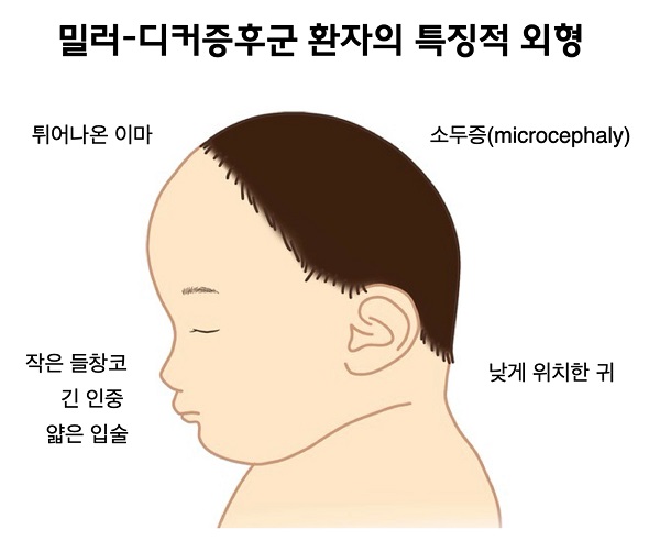 밀러-디커증후군 환자의 특징적 외형 그림-튀어나온 이마,소두증(microcephaly),작은 들창코,긴 인중,얇은 입술, 낮게 위치한 귀