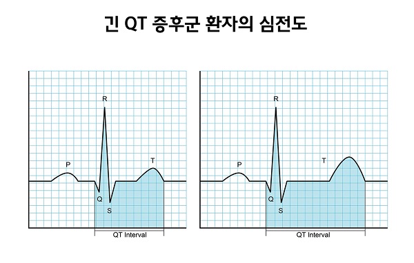 [7년 전 오늘] 긴 QT 증후군(long QT syndrome,LQTS)