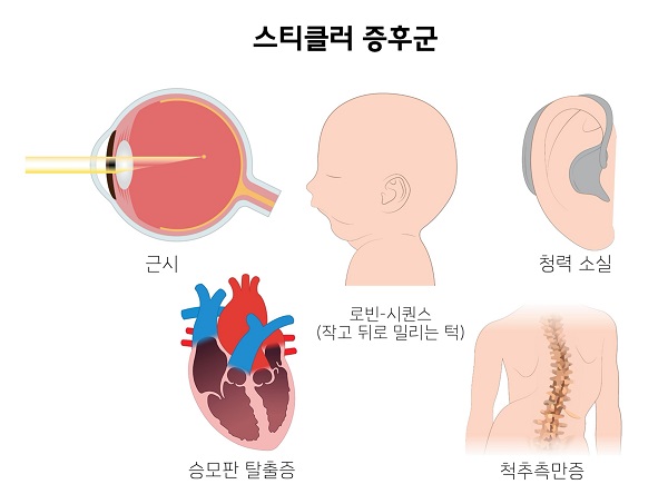 스틸클러 증후군 그림-근시,로빈-시퀀스(작고 뒤로 밀리는 턱), 청력소실, 승모판 탈출증, 척추측만증
