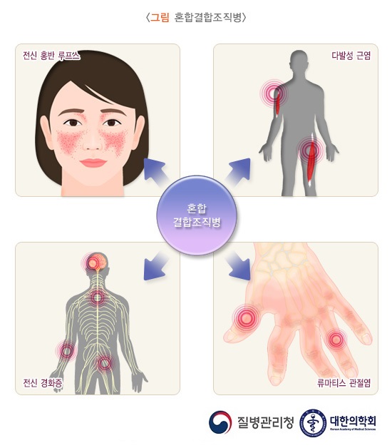 결합 조직 림프절