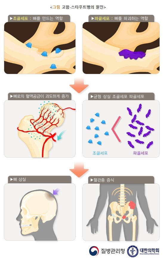 고함-스타우트 병의 원인: 뼈로의 혈액공급이 과도하게 증가하여 조골세포(뼈를 만드는 역할)보다 파골세포(뼈를 파괴하는 역할)의 수가 증가하여 균형이 상실되는 과정을 통해 뼈 상실, 혈관종 증식이 발생