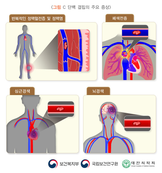 C 단백 결핍의 주요 증상