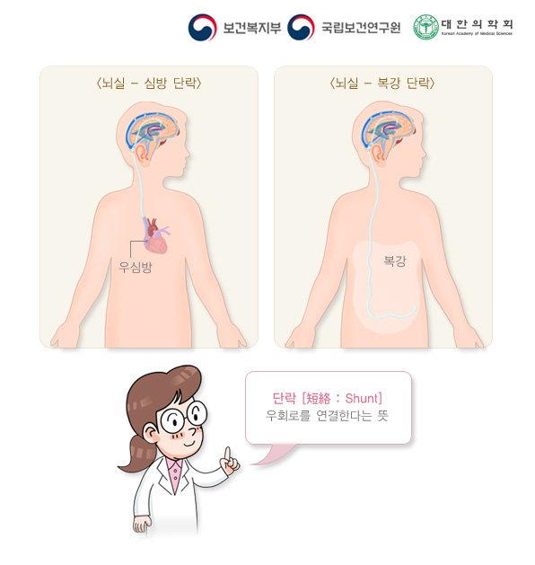 뇌실-복강 단락