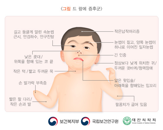 드 랑에 증후군