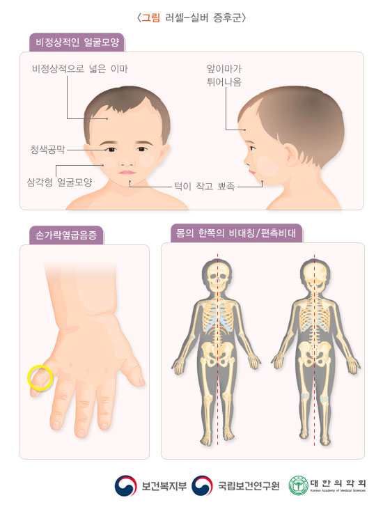 러셀-실버 증후군