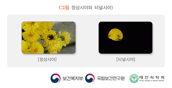 정상시야와 터널시야 비교 이미지. 보건복지부, 국립보건연구원, 대한의학회