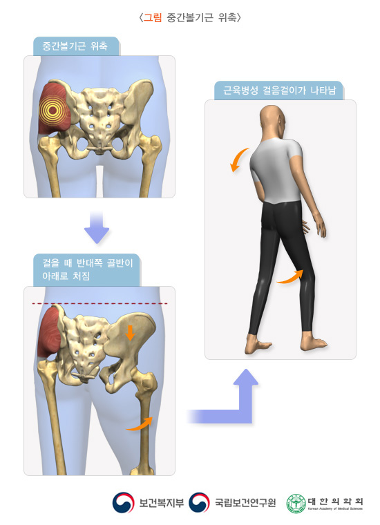 중간볼기근 위축