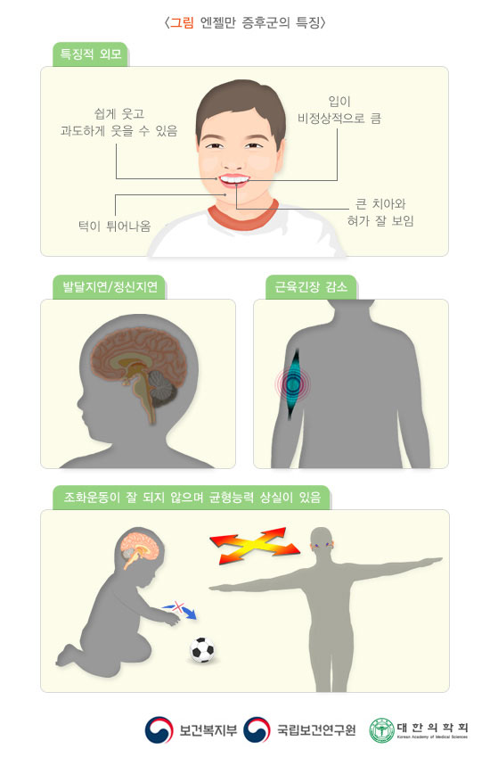 엔젤만 증후군의 특징적 그림: 쉽게 웃고 과도하게 웃을 수 있음, 입이 비정상적으로 큼, 턱이 튀어나옴, 큰 치아와 혀가 잘 보이는 특징적 외모와 발달지연/정신지연과 근육긴장 감소 및 조화운동이 잘 되지 않으며 균형능력 상실이 있음