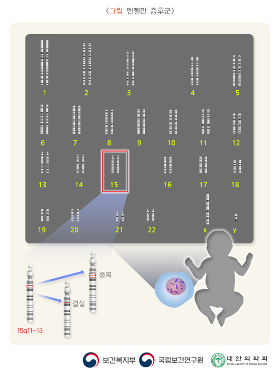 엔젤만 증후군: 15번 염색체의 장완에 위치(15q11-q13)하는 유전자 또는 유전자들의 중복이나 결손으로 일어난다고 생각되어짐