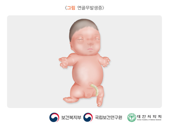 연골무발생증