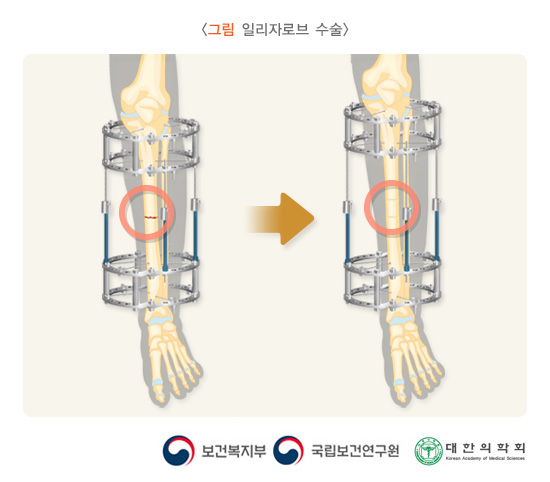 일리자로브 수술