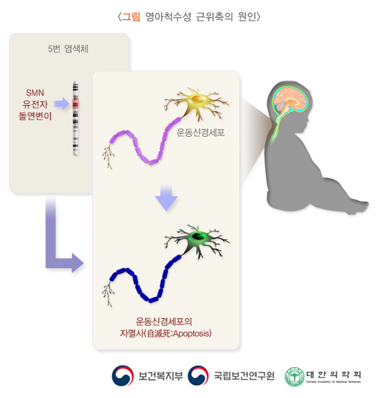 영아척수성 근위축의 원인