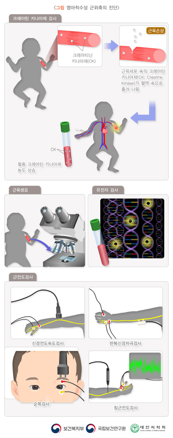 영아척수성 근위축의 진단