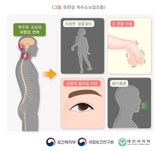 전성 척수소뇌실조증