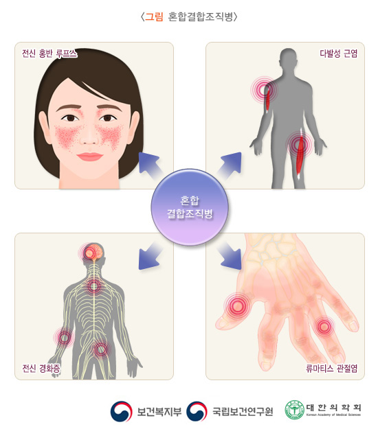 혼합결합조직병