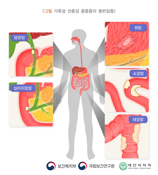 그림 가족성 선종성 용종증의 동반암종. 담관암, 십이지장암, 위암, 소장암, 대장암. 보건복지부, 국립보건연구원, 대한의학회.