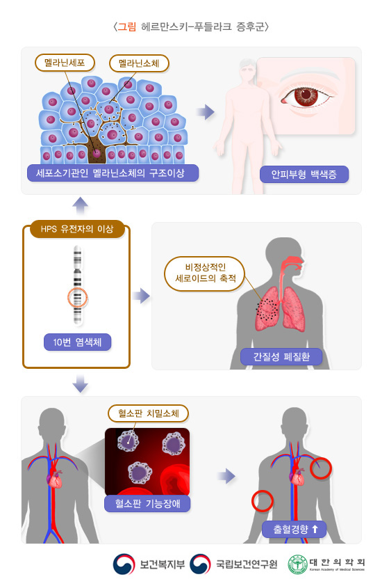 헤르만스키-푸들라크-증후군