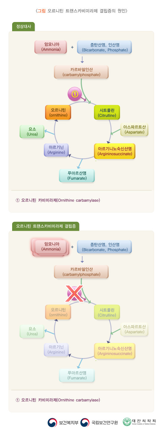 오르니틴 트랜스카비미라제 결핍증의 원인