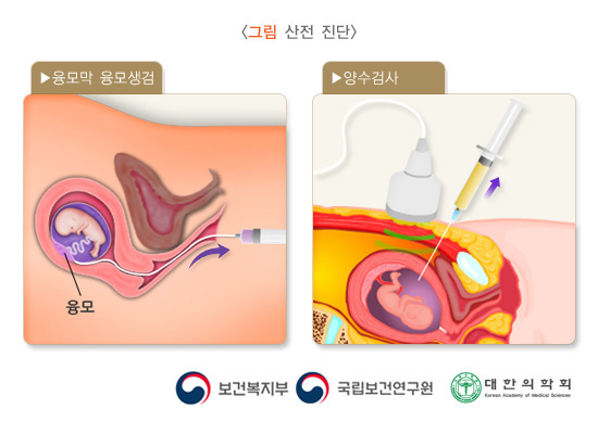 산전진단
