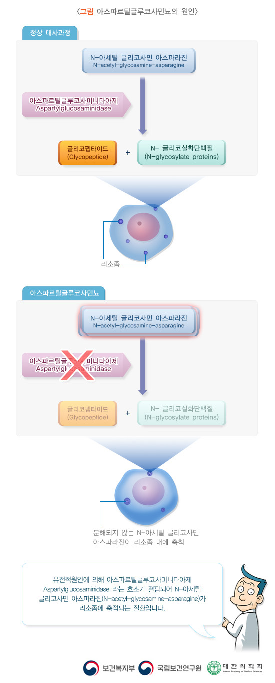 아스파르틸글루코사민뇨의 원인