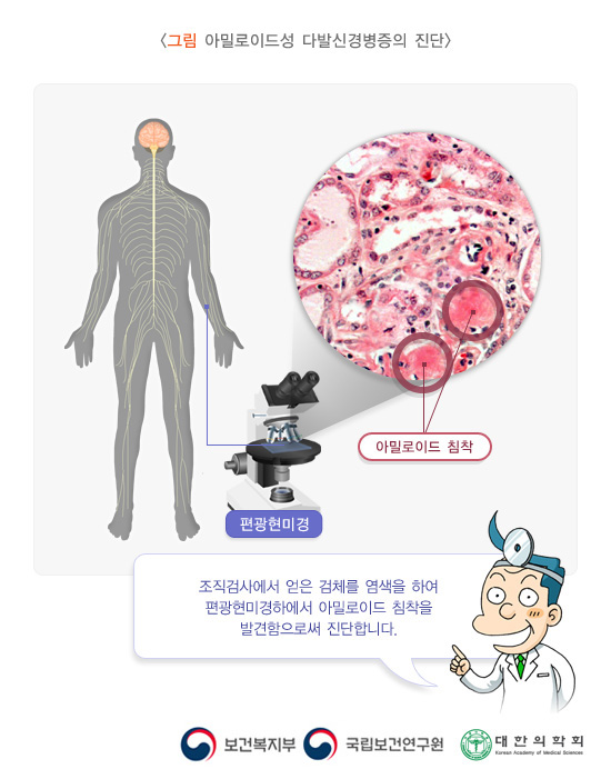 아밀로이드성 다발신경병증의 진단. 조직검사에서 얻은 검체를 염색을 하여 편광현미경하에서 아밀로이드 침착을 발견함으로써 진단합니다.