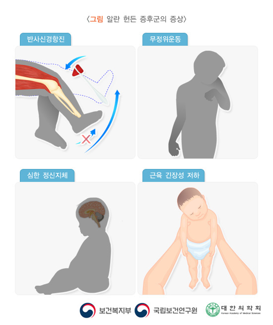 알란 헌든 증후군의 증상: 반사신경항진, 무정위운동, 심한 정신지체, 근육 긴장성 저하