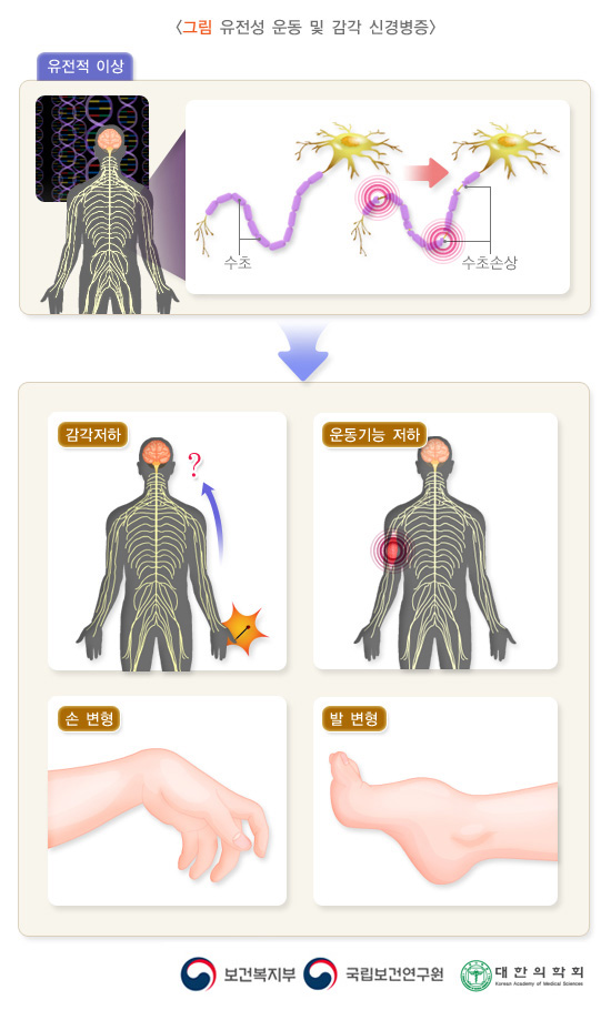 유전성 운동 및 감각 신경병증