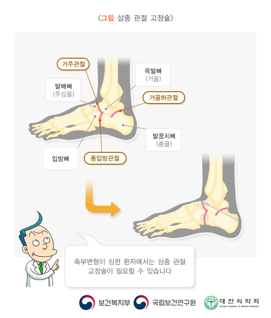 삼중관절고정술