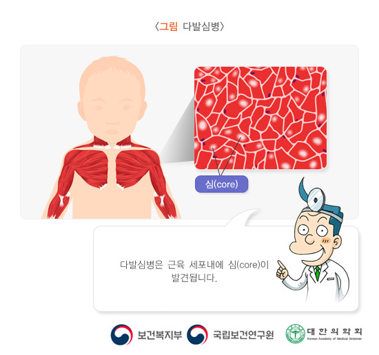 다발심병
