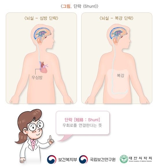 단락(shunt)