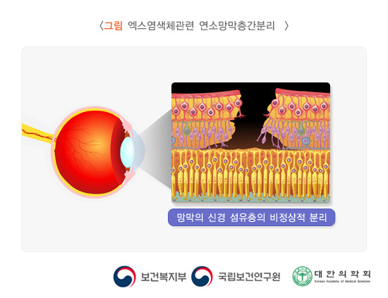 엑스염색체관련 연수망막층간분리