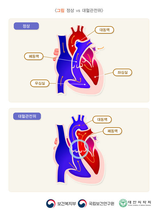 정상 vs 대혈관전위