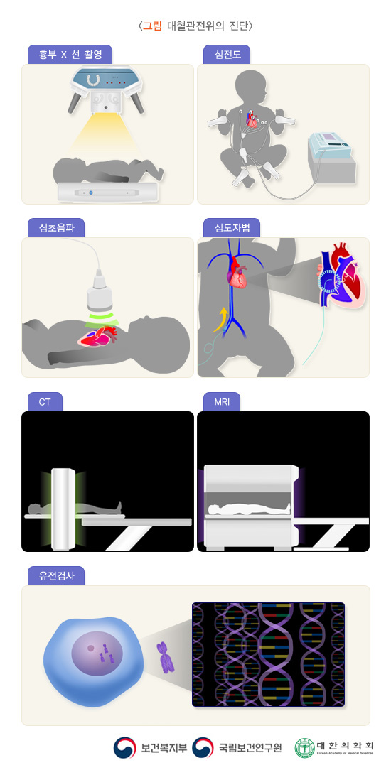 대혈관전위의 진단