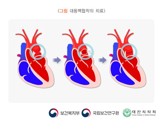 대동맥협착의 치료