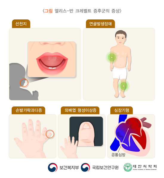 엘리스 반 크레벨트 증후군의 증상