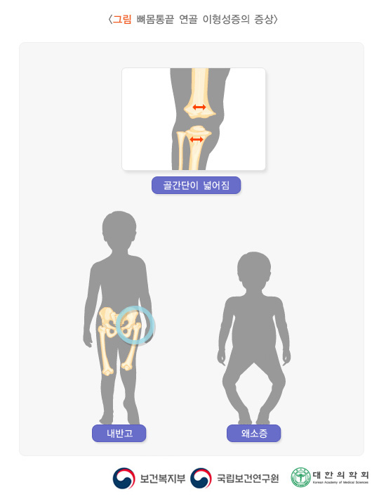 뼈몸통끝 연골 이형성증의 증상