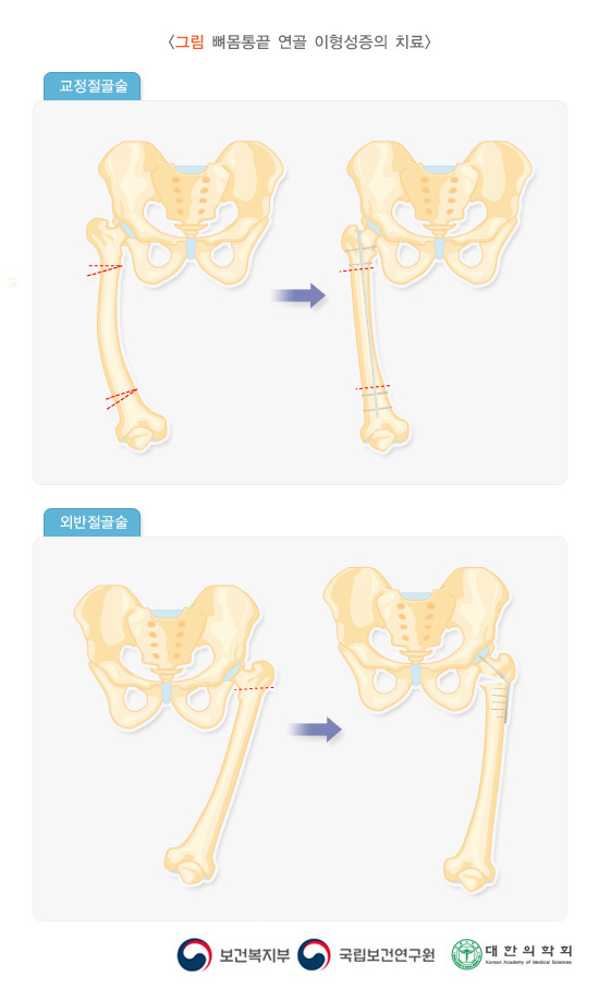 뼈몸통끝 연골 이형성증의 치료